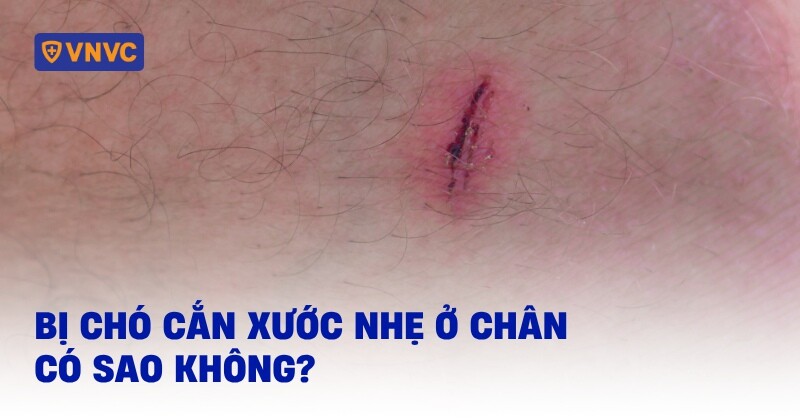 Bị chó cắn xước nhẹ ở chân có sao không? Cách xử lý an toàn